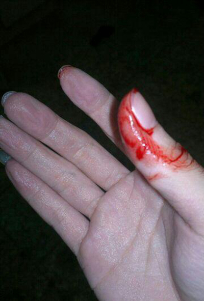 手指流血的图片 伤口图片