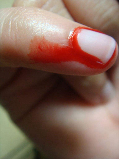 手指伤口图片真实流血图片