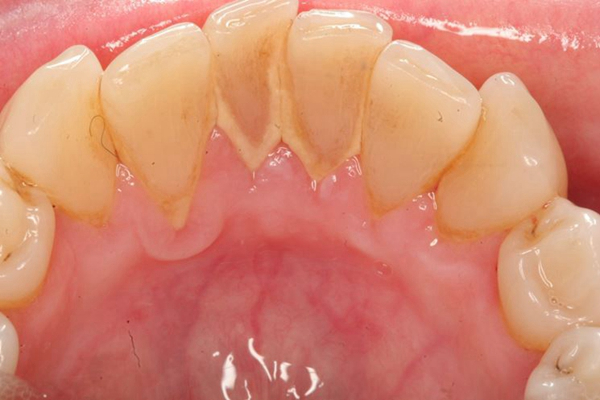 牙釉质损伤图片5