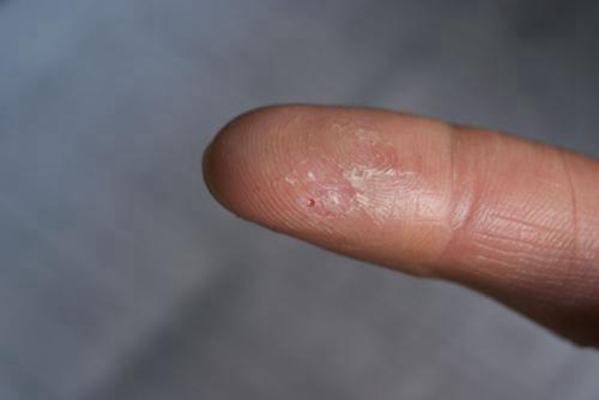 手指湿疹 初期图片