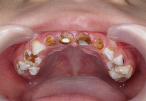 虫牙真实图片 (1)