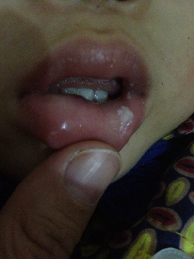 口腔黏膜小白点图片