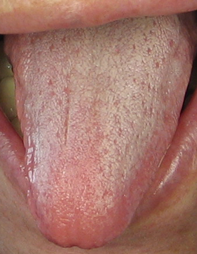 舌边白斑图片