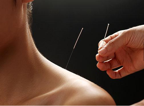 今天我们来聊聊针灸是怎样治病的,中医认为,针灸最主要的作用是"