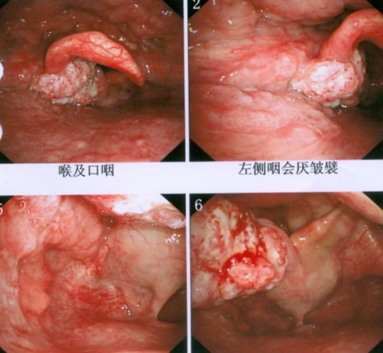 咽癌早期图片图片