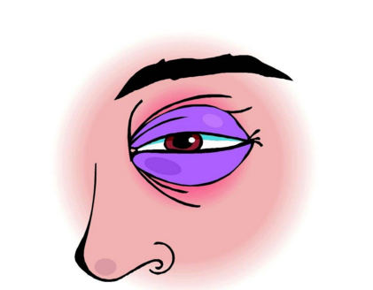 眼癌的早期症状图片 (1)