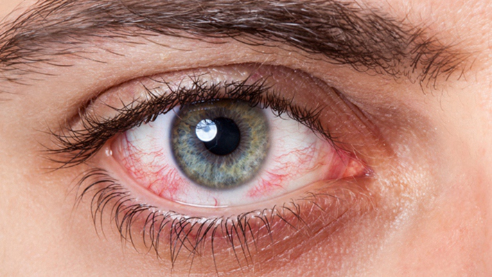 眼癌的早期症状图片 (14)