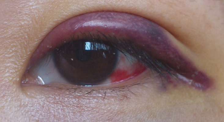 眼癌的早期症状图片 (2)