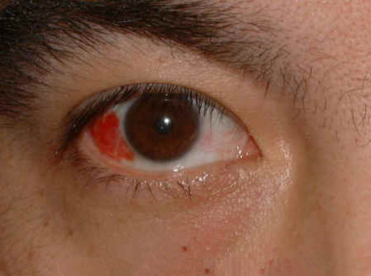 眼癌的早期症状图片 (22)