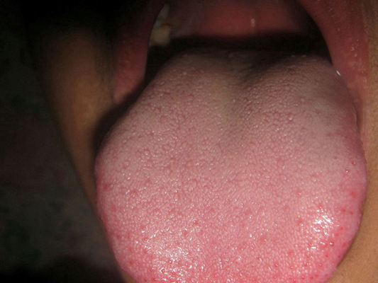 舌头发紫图片50
