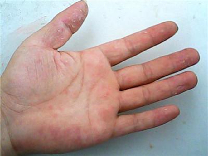 水疱型手癣与疱疹区别