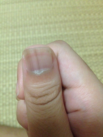 缺钙指甲图片8
