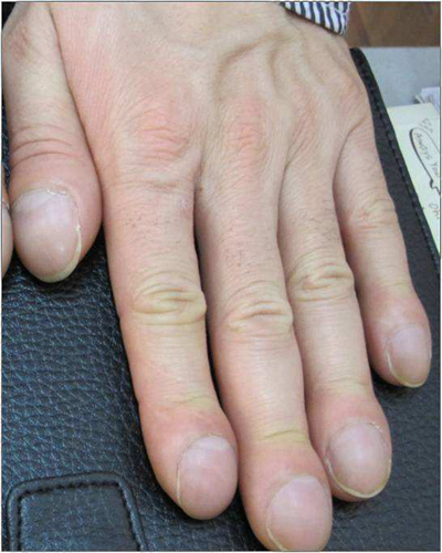 手指关节肿大图片 (26)