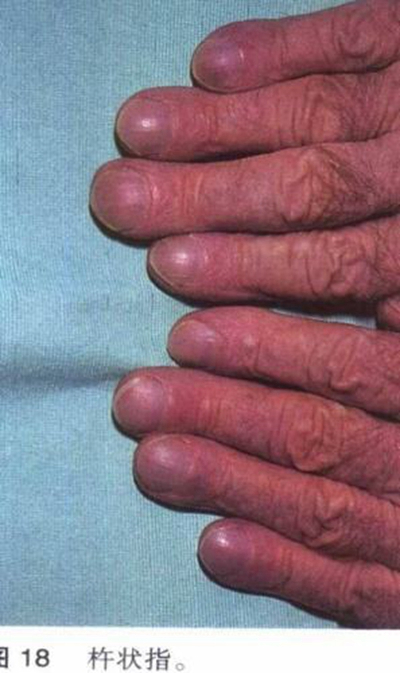 手指关节肿大图片 (4)