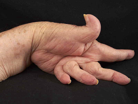 手指关节肿大图片 (37)