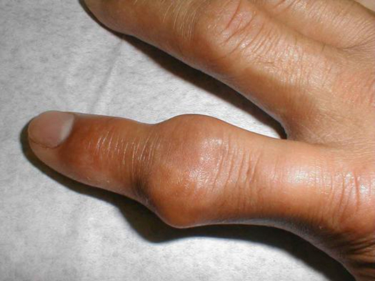 手指关节肿的照片图片