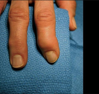 手指关节肿大图片 (48)