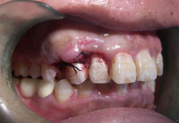牙癌的症状和外部图片 (20)