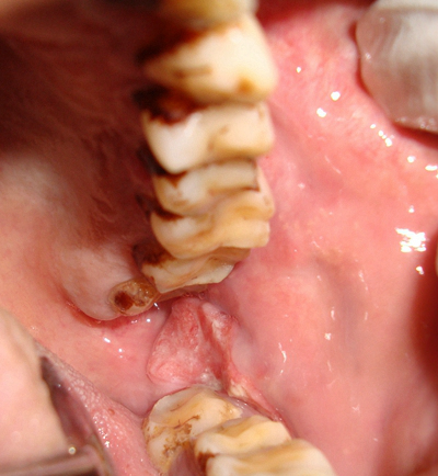 牙癌的症状和外部图片 (26)