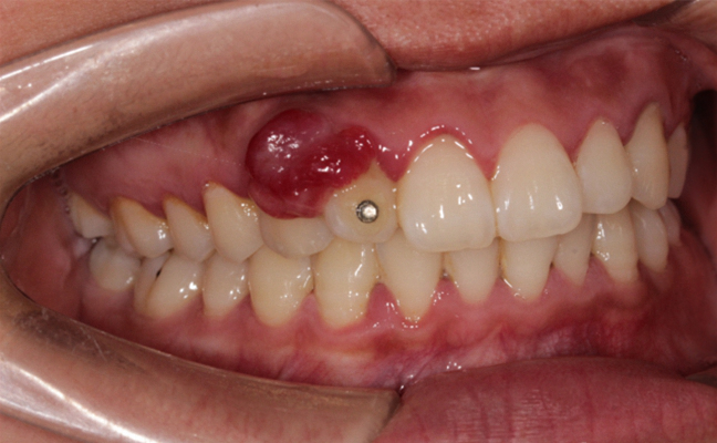 牙龈肿瘤症状图片