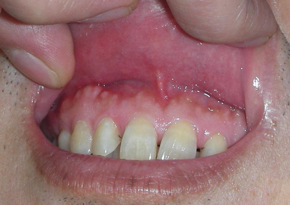 牙龈斑疹图片