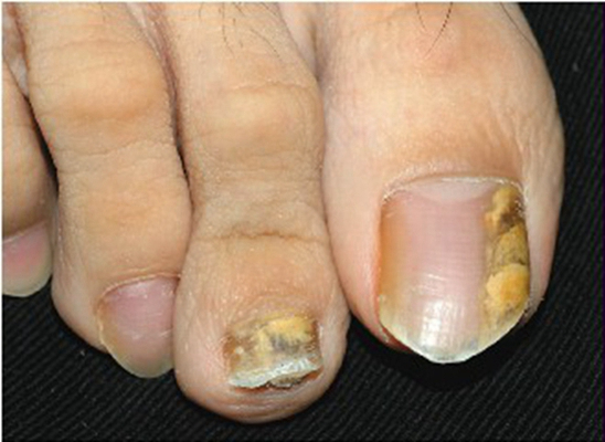 初期灰指甲的症状图片图片