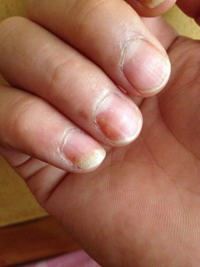 灰指甲初期症状 (55)