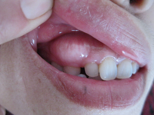 牙齿瘤初期症状图片图片