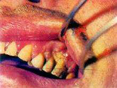 牙龈癌早期症状图片(2)