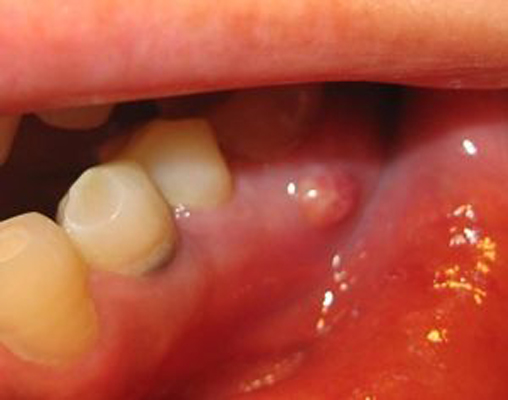 牙龈癌初期图片