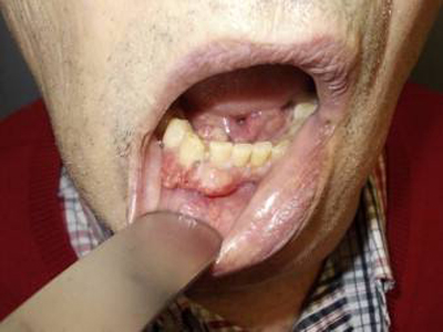 牙龈癌的早期图片图片