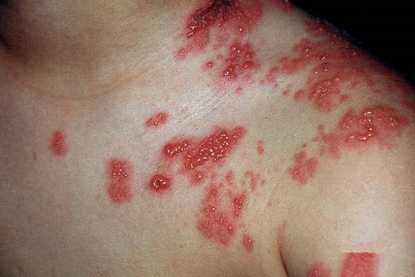 皮肤疮疡肿毒图片