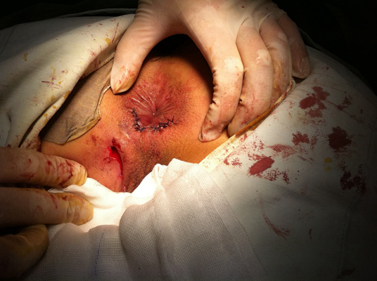 肛周脓肿照片 早期图片