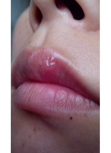 湿疹性唇炎图片图片