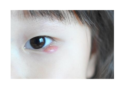 眼睛麦粒肿初期图片图片