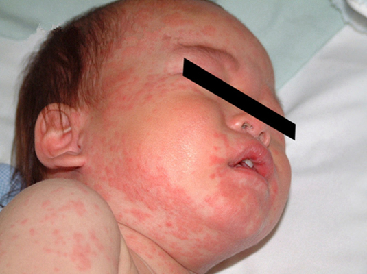 小孩麻疹图片 (12)