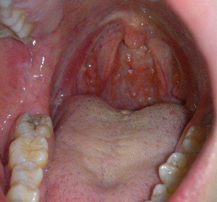 喉咙长了个囊肿图片 (6)