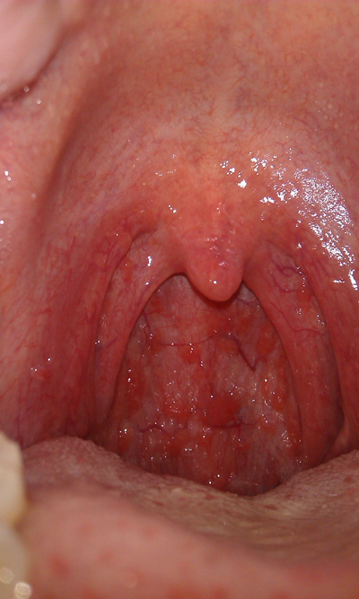 喉咙长了个囊肿图片 (65)