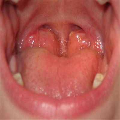 喉咙长了个囊肿图片 (51)