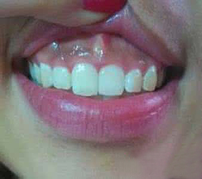 儿童牙癌的早期图片图片