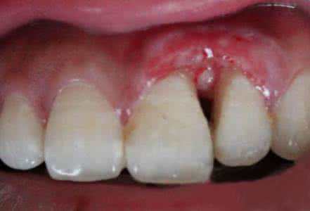 儿童牙癌的早期图片图片