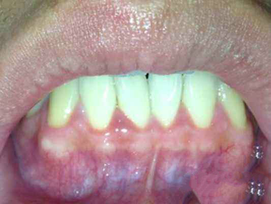 牙龈癌的症状图片图片
