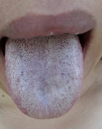 舌头纹路图片