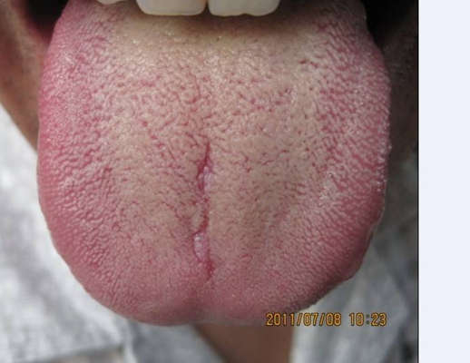 艾滋病舌头图片46
