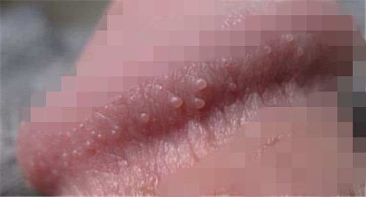 尿道口疱疹图片初期图片