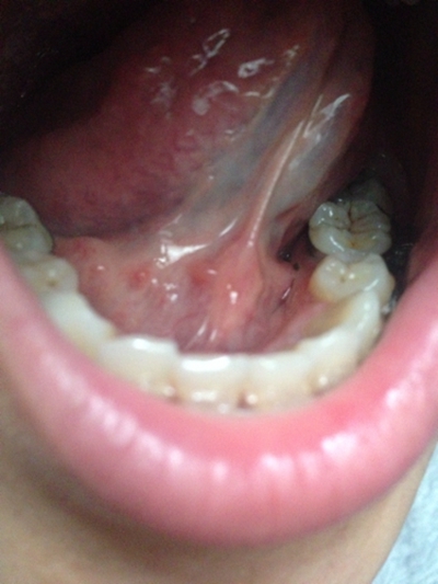 淋巴滤泡咽喉炎图图片图片