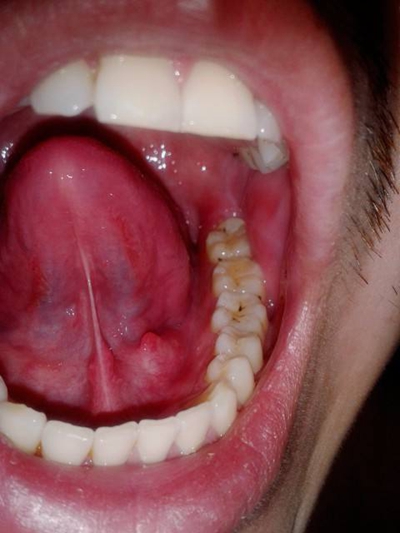 咽腭弓滤泡图片