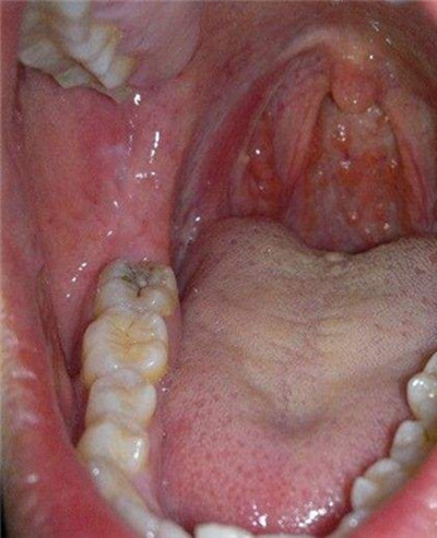 正常咽喉滤泡增生图片图片