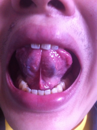 舌头下面有丝状肉芽图片