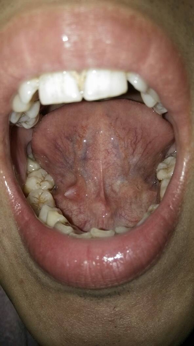 舌头下长肉芽图片说明图片